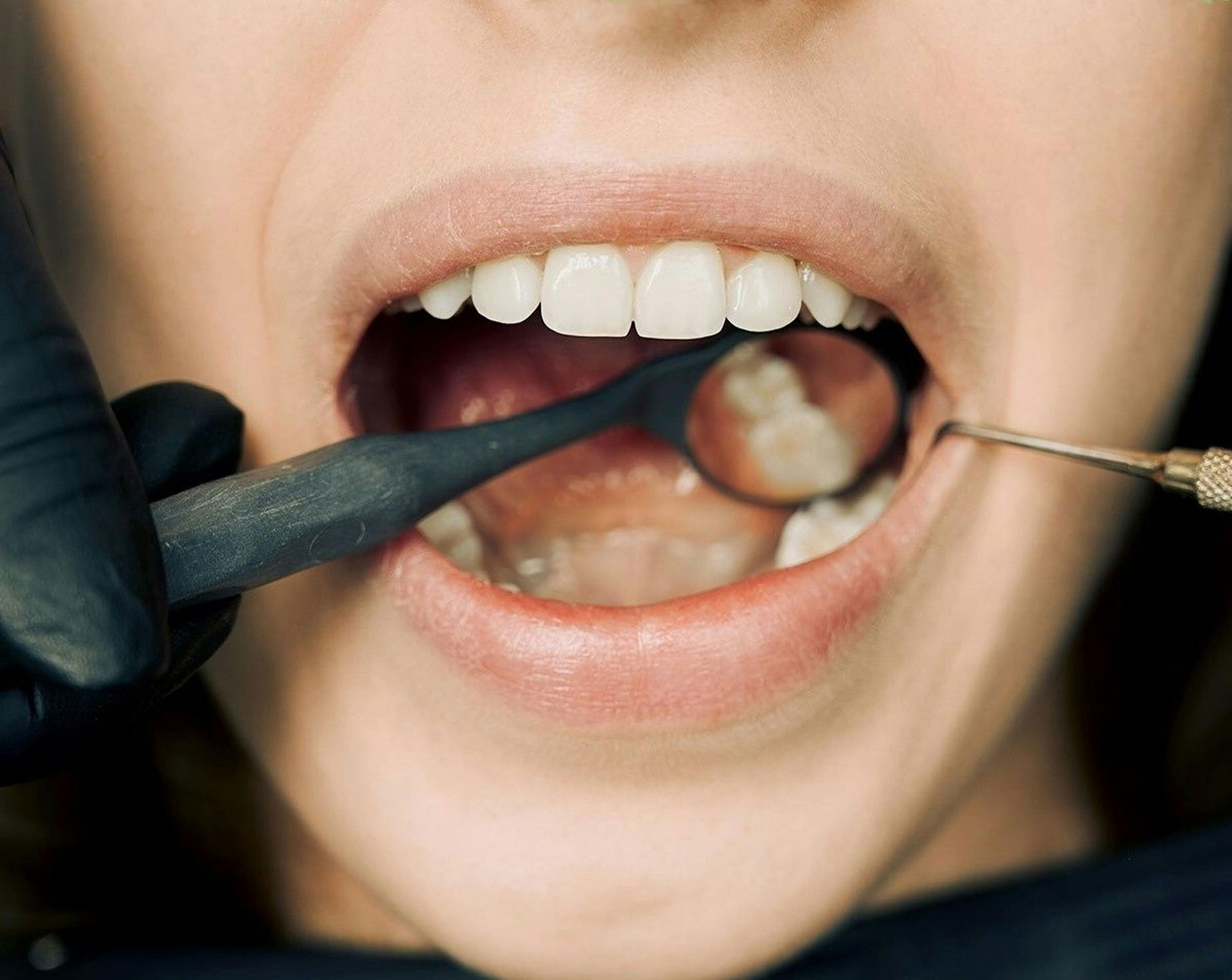impianti dentali senza osso