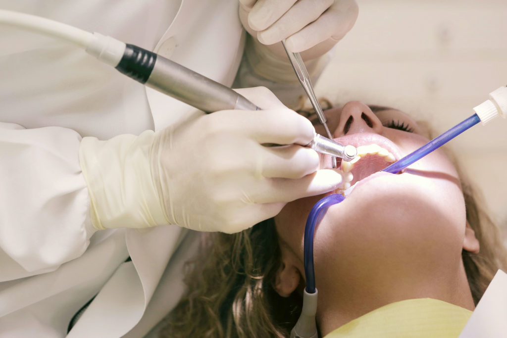 denti con il tartaro fa male