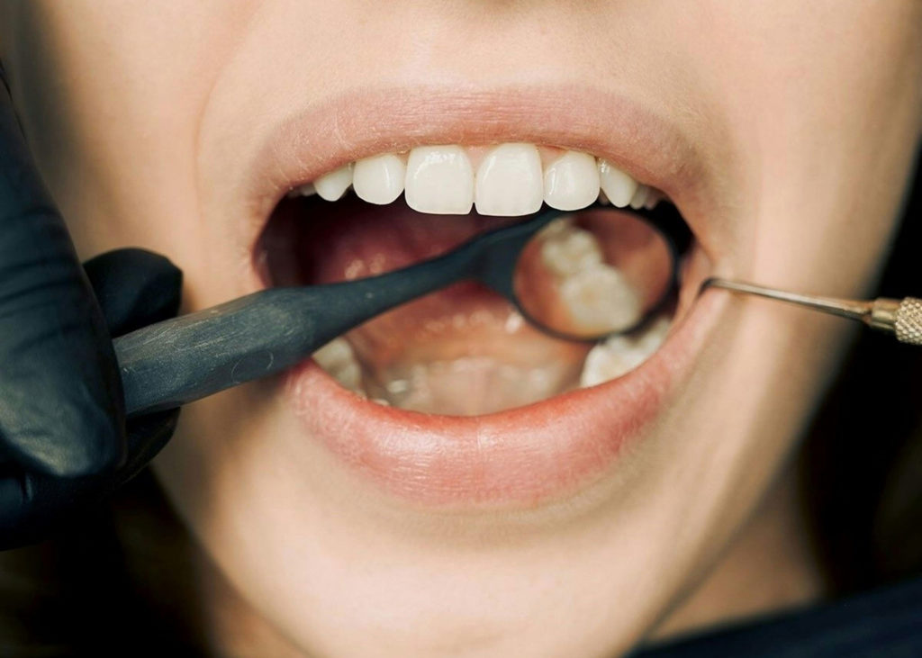 rimedi per il tartaro sui denti per eliminarlo