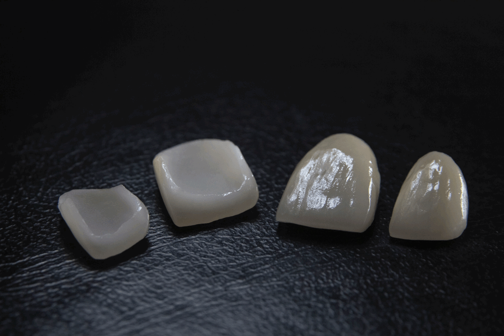 cosa sono le faccette dentali