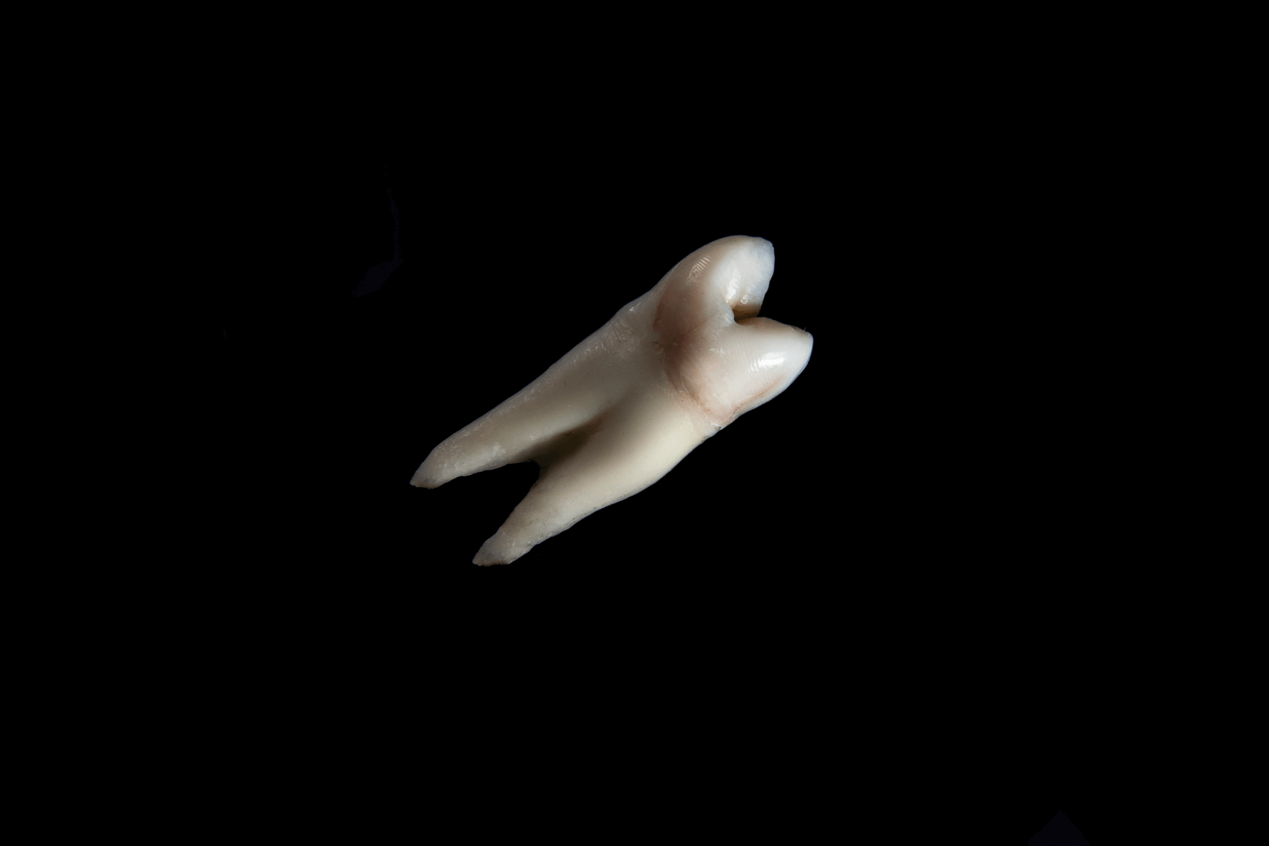 dente rotto alla radice o spezzato come comprarsi cause e rimedi