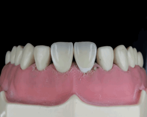 le faccette dentali rovinano i denti verità o mito