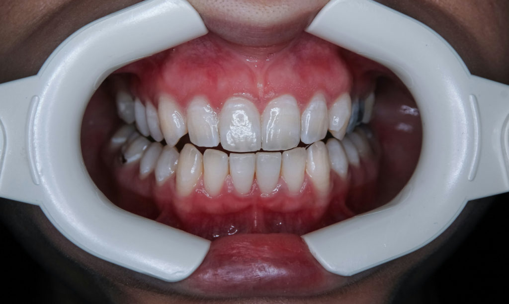 come riconoscere le macchie di caffè nei denti