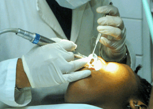 allergia a impianti dentali