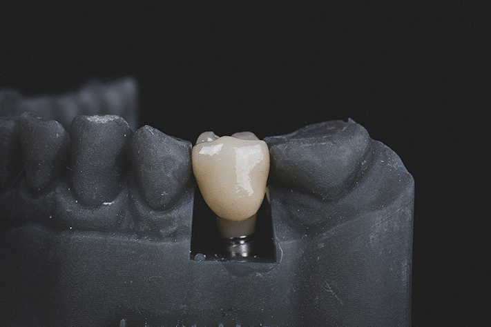 cosa può causare allergia negli impianti dentali