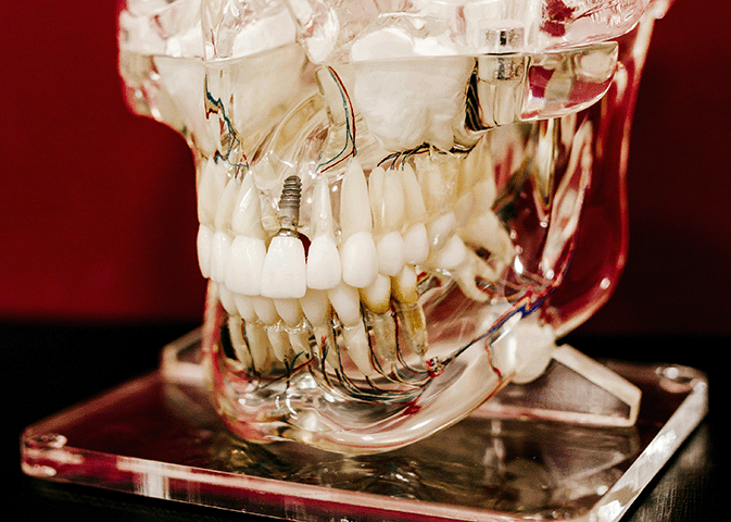 fattori da valutare per capire se un impianto dentale è tra i migliori al mondo
