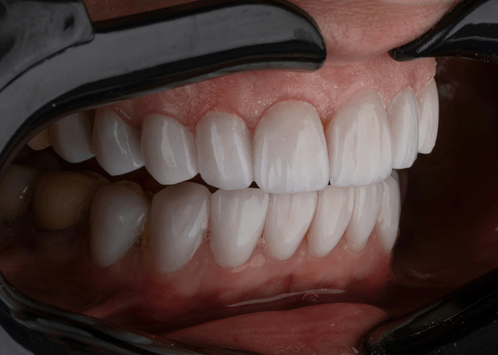 l'importanza di optare per i migliori impianti dentali del 2025